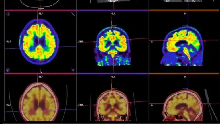 MRI scan brain activity | Déjà Vu