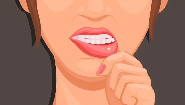 Oral mucositis treated by magic mouthwash | Magic Mouthwash Recipe
